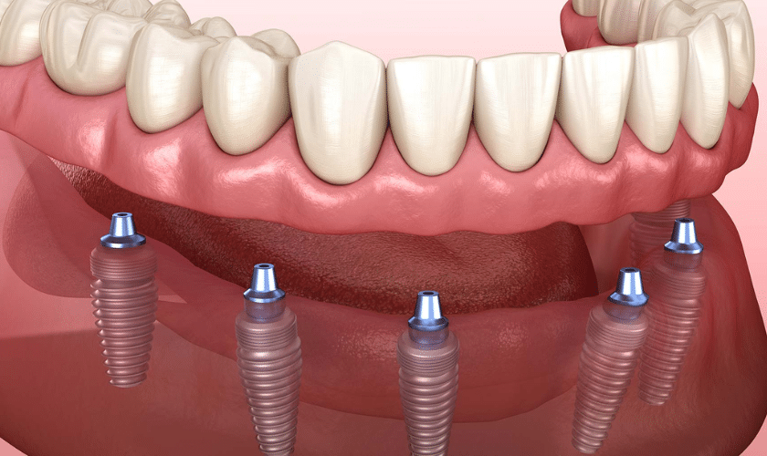 How To Take Care Of Full-Arch-Dental Implants?