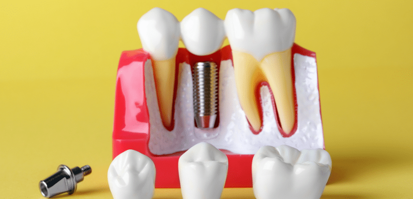 Why Should You Consider Dental Implants