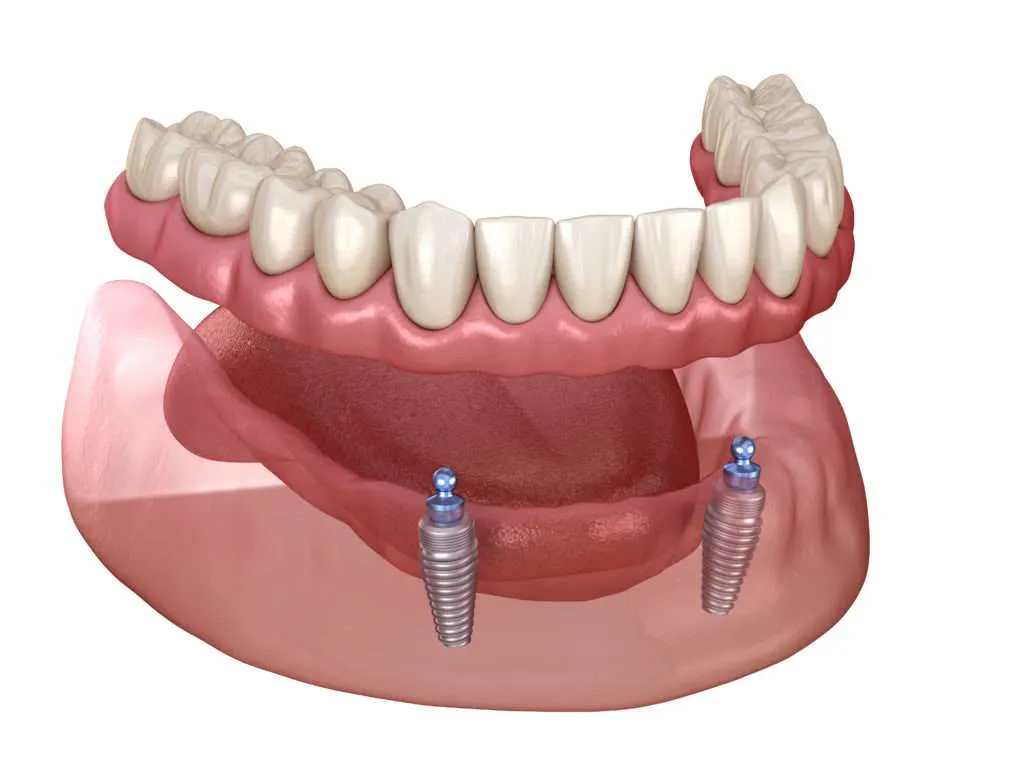 implant-supported dentures